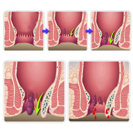 內(nèi)痔脫出怎么辦？