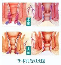 內(nèi)痔術前與術后對比圖